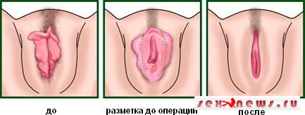 Лабиопластика: нюансы коррекции Лабиопластика: нюансы коррекции